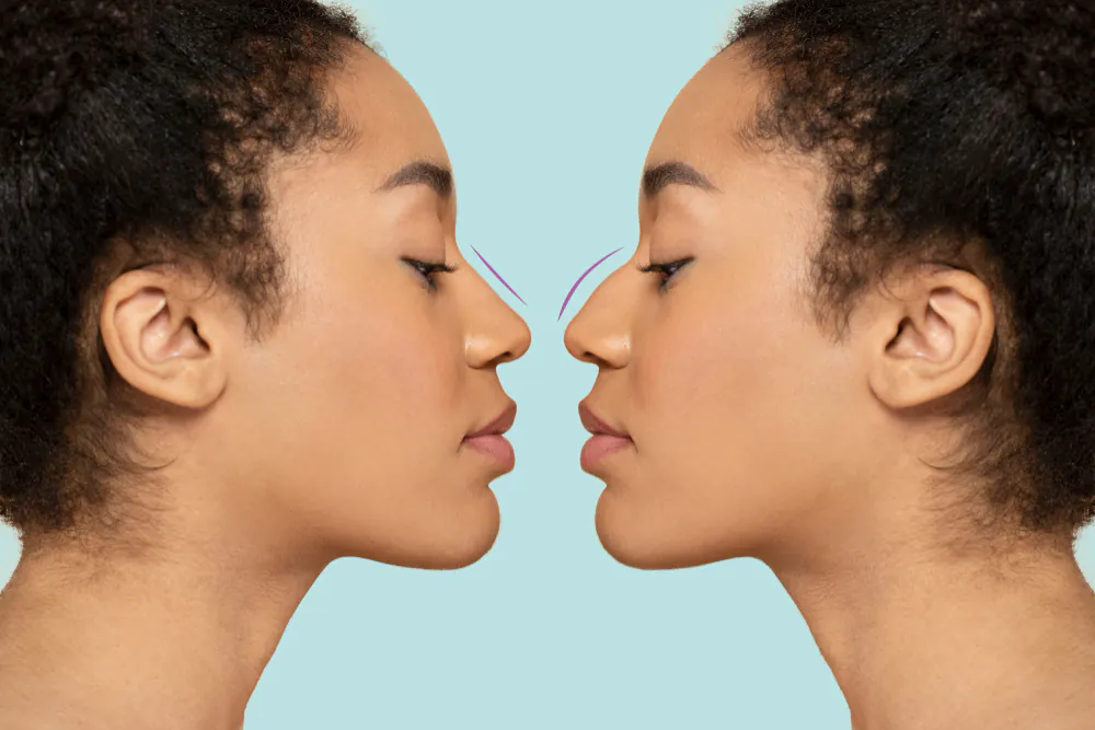 Rinoplastia e septoplastia: vale a pena fazer cirurgias combinadas?