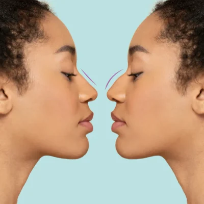 Rinoplastia e septoplastia: vale a pena fazer cirurgias combinadas?